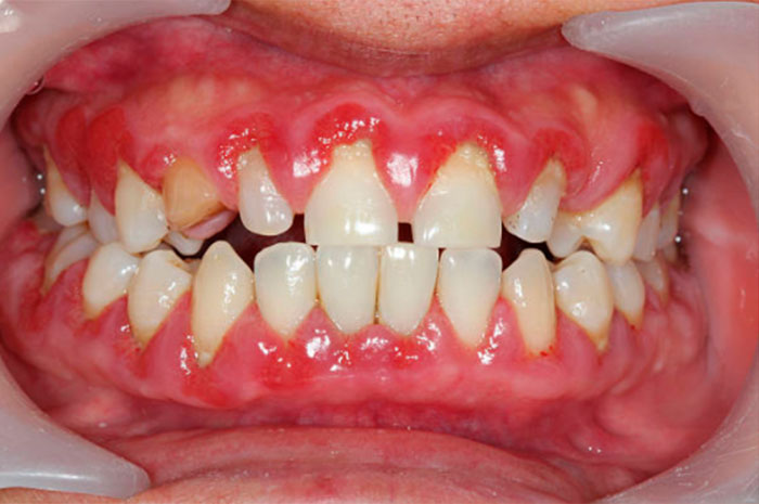 DOENÇA PERIODONTAL