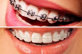 APARELHOS ORTODONTICOS